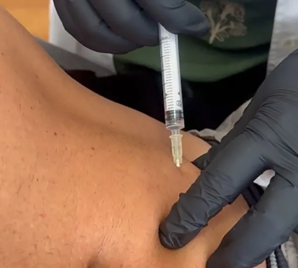 Tratamiento corporal con enzimas lipolíticas EMG