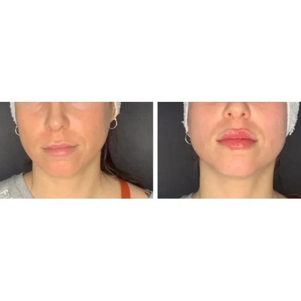 Rellenos de ácido hialurónico labios pómulos EMG